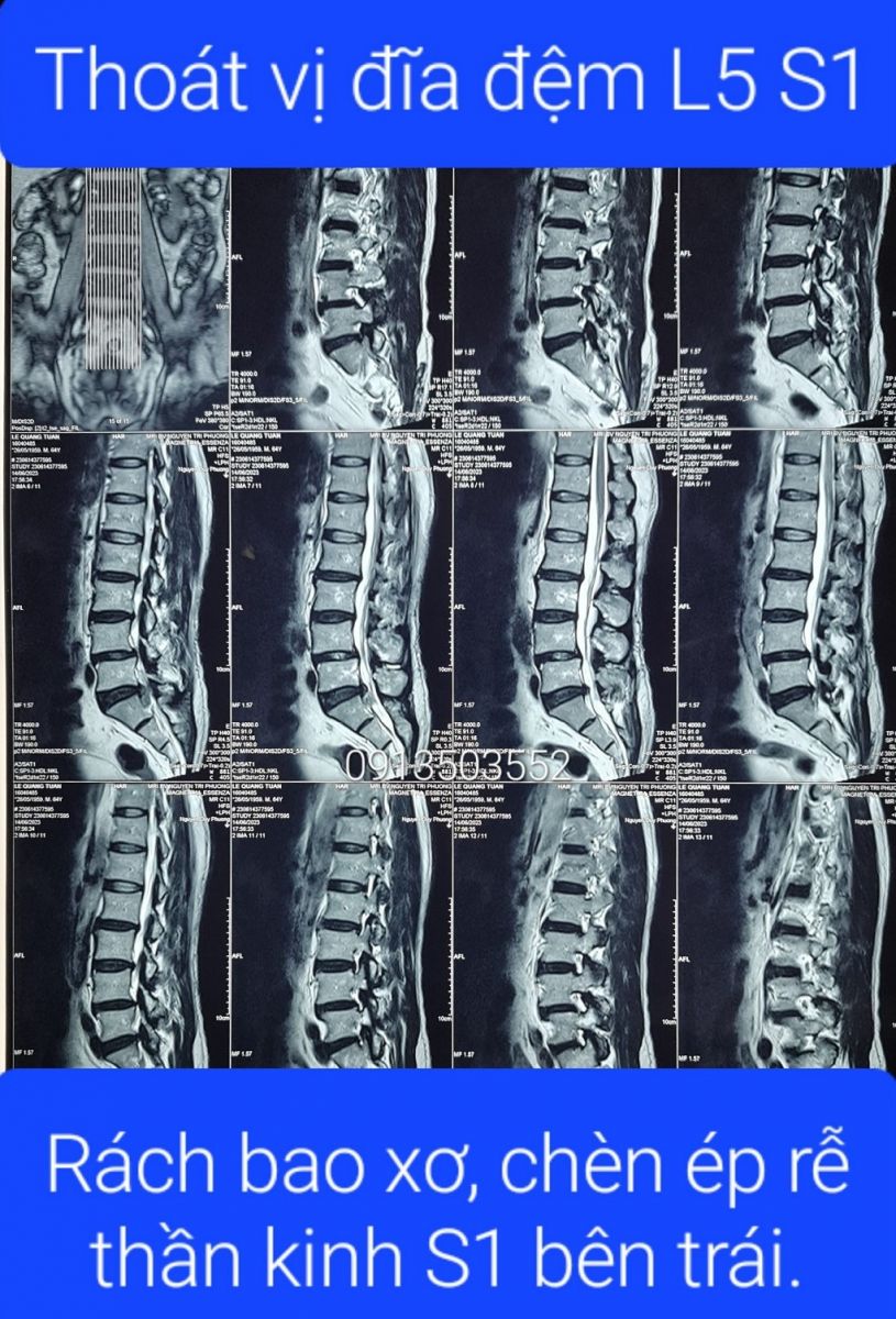 Thoát vị đĩa đệm L5 S1